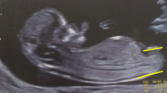echographie fille bourgeon